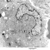 1F2 Langerhan's Cell Histiocytosis (Case 1) EM 009 - Copy