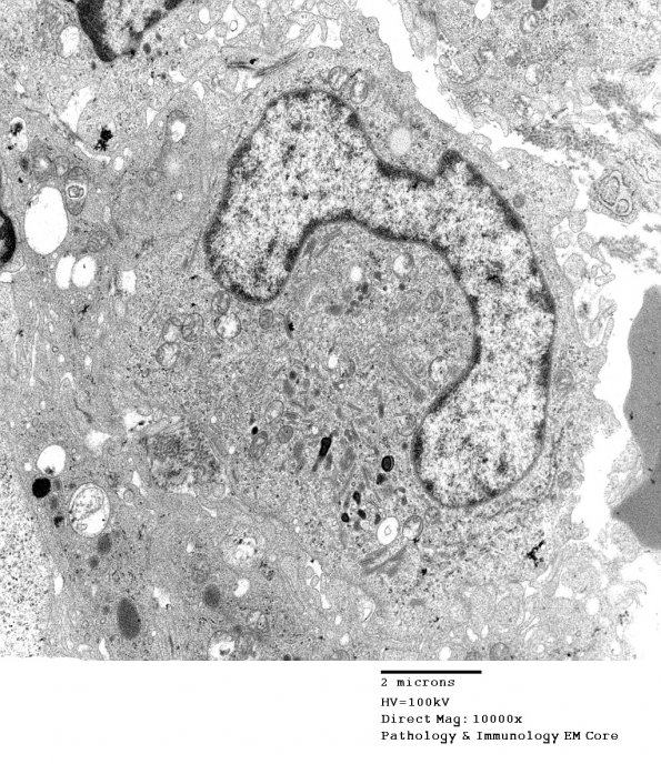 1F2 Langerhan's Cell Histiocytosis (Case 1) EM 009 - Copy