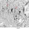 1F3 Langerhan's Cell Histiocytosis (Case 1) EM 010 - Copy copy