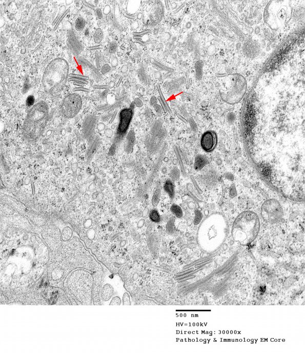 1F3 Langerhan's Cell Histiocytosis (Case 1) EM 010 - Copy copy