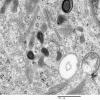 1F4 Langerhan's Cell Histiocytosis (Case 1) EM 011 - Copy