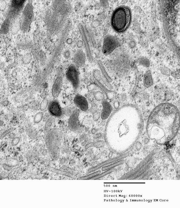 1F4 Langerhan's Cell Histiocytosis (Case 1) EM 011 - Copy