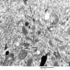 1F5 Langerhan's Cell Histiocytosis (Case 1) EM 013 - Copy