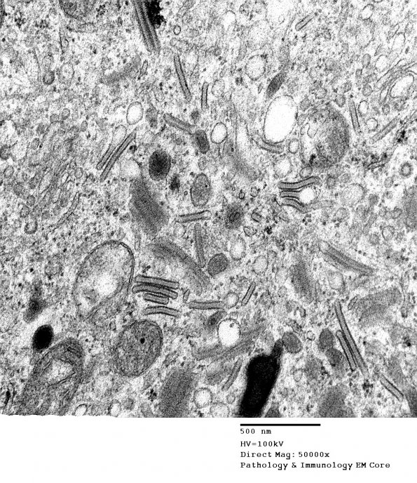 1F5 Langerhan's Cell Histiocytosis (Case 1) EM 013 - Copy