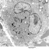 1F6 Langerhan's Cell Histiocytosis (Case 1) EM 019 - Copy