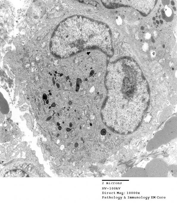 1F6 Langerhan's Cell Histiocytosis (Case 1) EM 019 - Copy