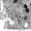 1F7 Langerhan's Cell Histiocytosis (Case 1) EM 026 - Copy