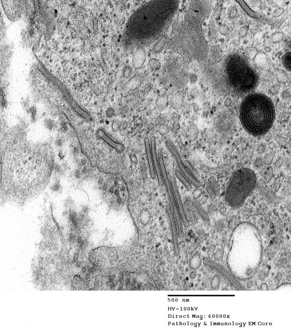 1F7 Langerhan's Cell Histiocytosis (Case 1) EM 026 - Copy