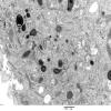 1F8 Langerhan's Cell Histiocytosis (Case 1) EM 022 - Copy