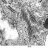 1F9 Langerhan's Cell Histiocytosis (Case 1) EM 028 - Copy