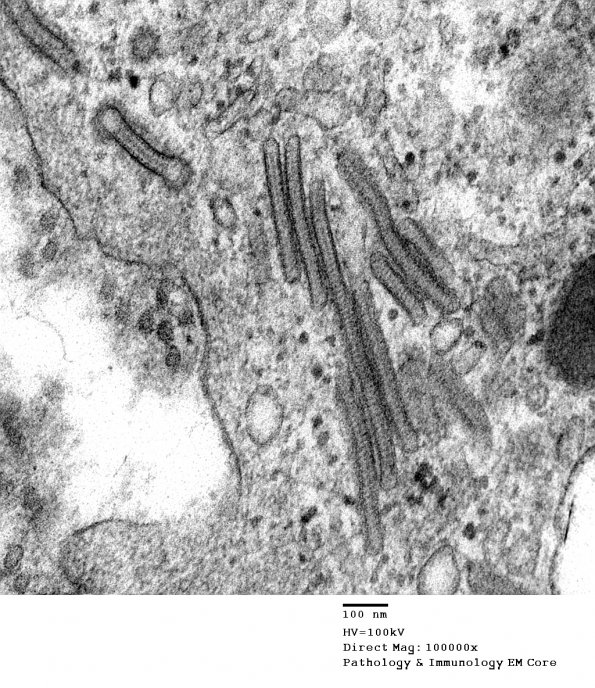 1F9 Langerhan's Cell Histiocytosis (Case 1) EM 028 - Copy