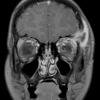 20A LCH (Case 20) MRI 4 - Copy