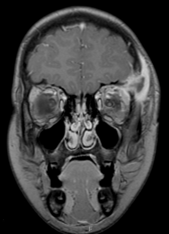 20A LCH (Case 20) MRI 4 - Copy