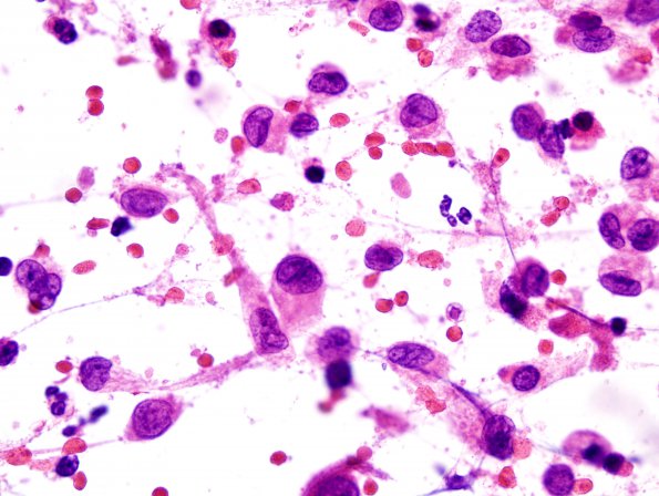 20B1 LCH (Case 20) H&E smear 1