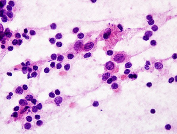 22A1 LCH (Case 22) H&E smear 4.jpg