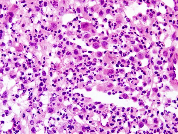 22A2 LCH (Case 22) H&E frozen 1.jpg