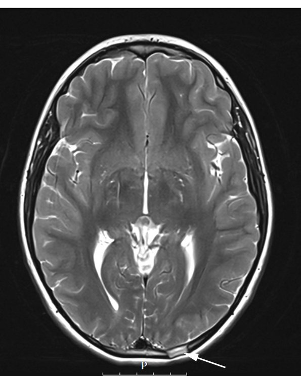 24A1 LCH (Case 24) T2 noC - Copy copy