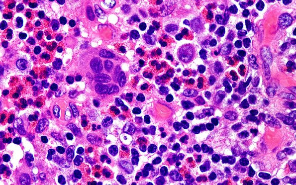 24B12  LCH (Case 24) H&E 100X 3