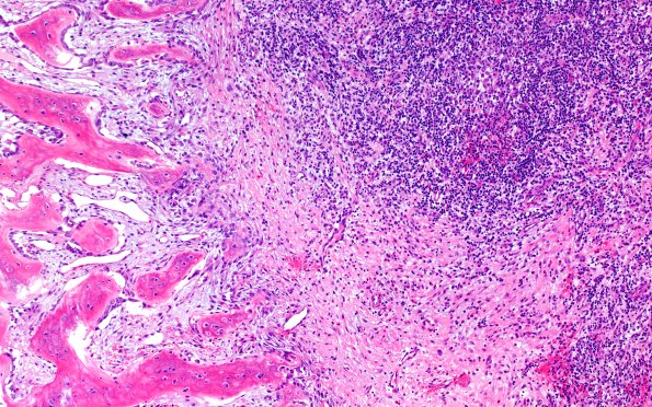 24B2 LCH (Case 24) H&E 10X 3