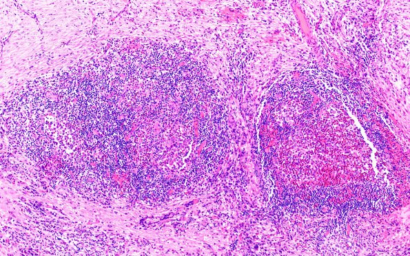 24B3 LCH (Case 24 H&E 10X 1B