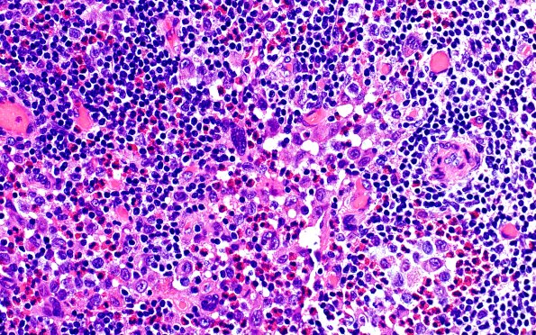 24B5 LCH (Case 24) H&E 40X 7