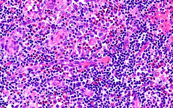 24B6 LCH (Case 24) H&E 40X 2