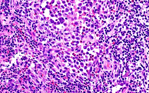 24B7 LCH (Case 24) H&E 40X 5