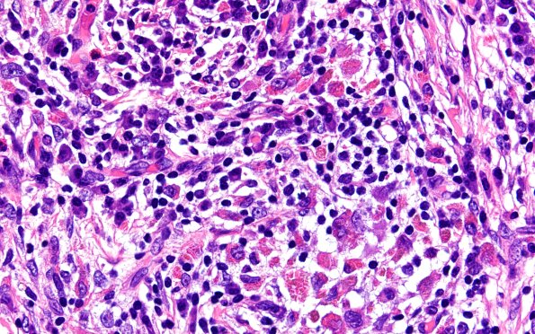 24B8 LCH (Case 24) H&E 40X 6