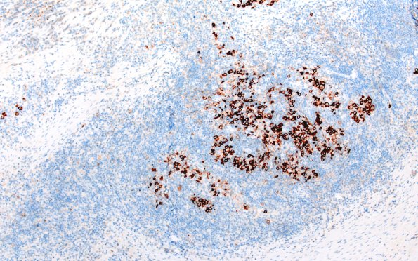 24C1 LCH (Case 24) CD1a 10X 2