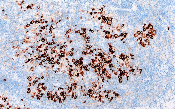 24C2 LCH (Case 24) CD1a 20X 2