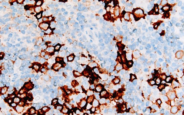 24C3 LCH (Case 24) CD1a 60X 2