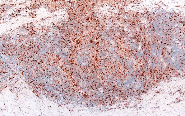 24D1 LCH (Case 24) CD68 10X 1