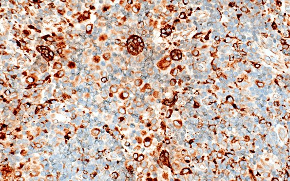 24D3 LCH (Case 24) CD68 40X 1