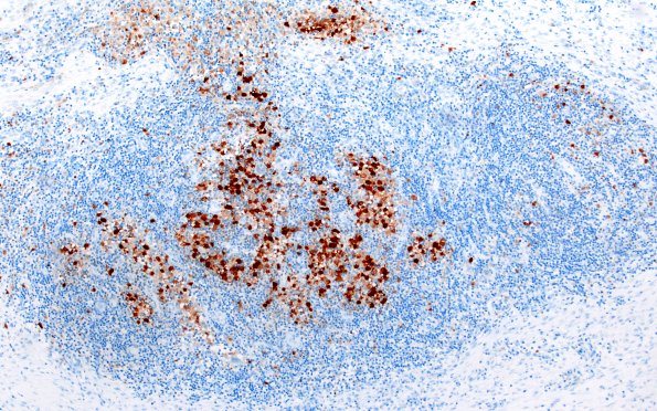 24E1 LCH (Case 24 S100 10X 1