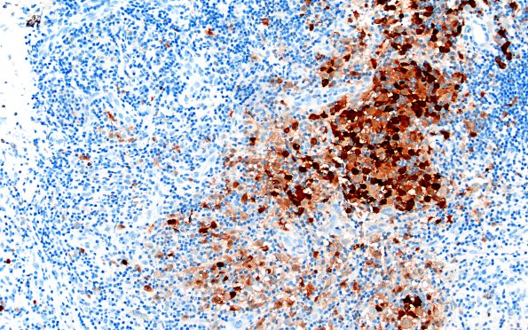 24E2 LCH (Case 24) S100 20X 1