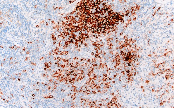 24F1 LCH (Case 24) BRAF 20X 2