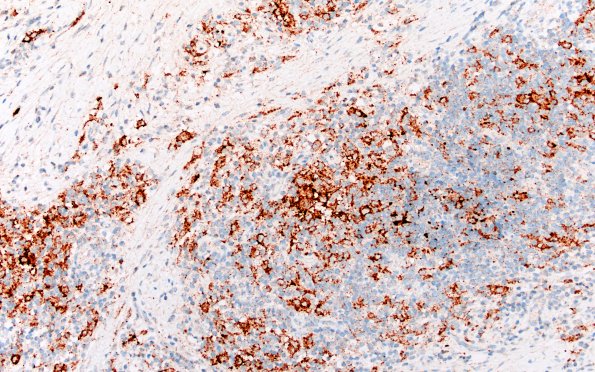 24F2 LCH (Case 24) BRAF 20X 3