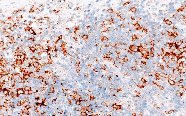 24F3 LCH (Case 24) BRAF 40X 2