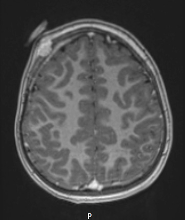 25A3 LCH (Case 25) T1W 2 - Copy