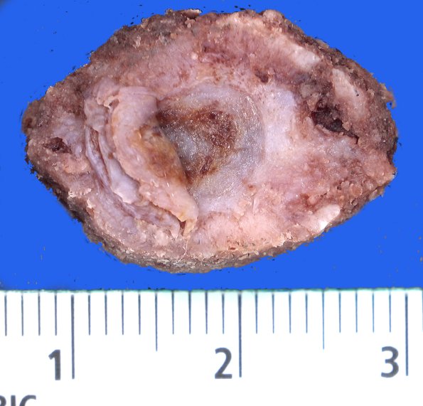 25B1 (Case 25)A2