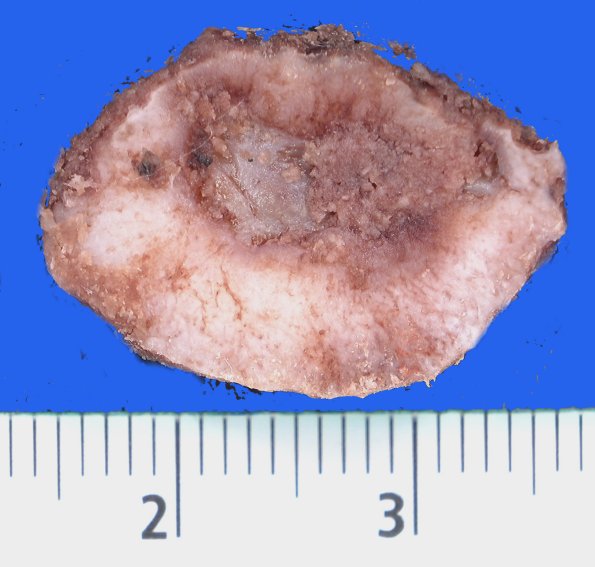 25B2 (Case 25)1A