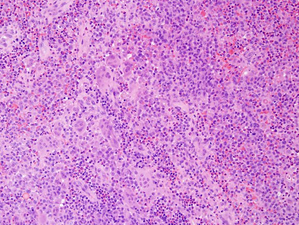 2A1 Langerhan's Cell Histiocytosis (Case 2) H&E 4