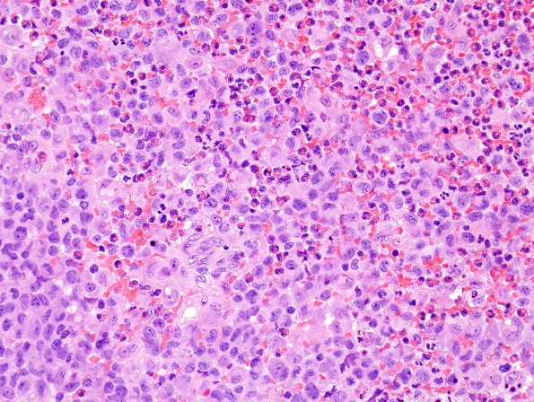 2A2 Langerhan's Cell Histiocytosis (Case 2) H&E 3