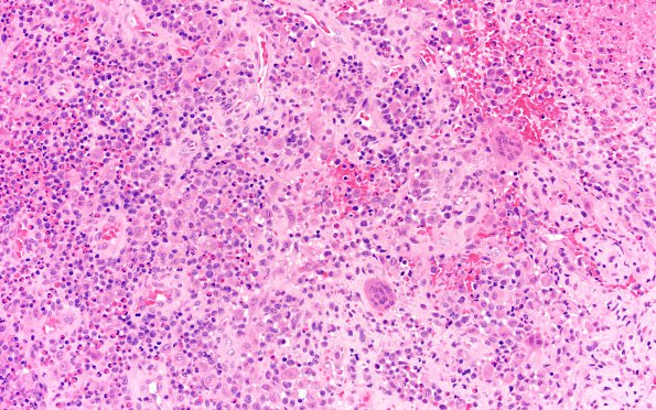 2A3 Langerhan's Cell Histiocytosis (Case 2) H&E 20X