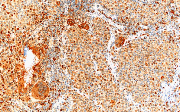 2B Langerhan's Cell Histiocytosis (Case 2) areaA CD68 20X