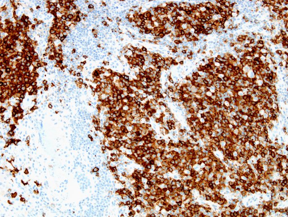 2C1 Langerhans Cell Histiocytosis (Case 2) CD1a 2