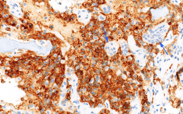 2C2 Langerhans Cell Histiocytosis (Case 2) areaA CD1a 40X 1 copy