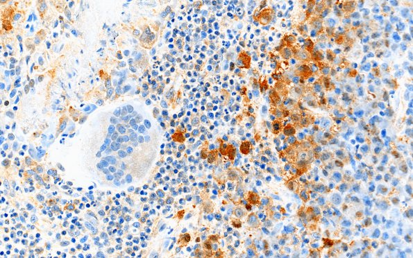 2D1 Langerhan's Cell Histiocytosis (Case 2) areaA S100 40X 3