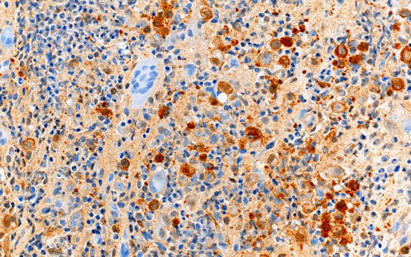 2D2 Langerhan's Cell Histiocytosis (Case 2) areaA S100 40X