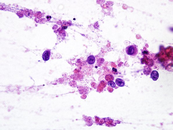 3A1 endLangerhan's Cell Histiocytosis (Case 3) H&E 7